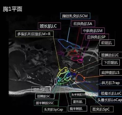 正常颈椎肌肉 MRI 横断位及三维重建图 正常颈椎肌肉 MRI 横断位及三维重建图