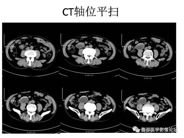 【病例】阑尾粘液囊肿1例CT影像表现