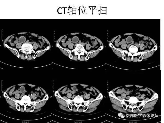 【病例】阑尾粘液囊肿1例CT影像表现