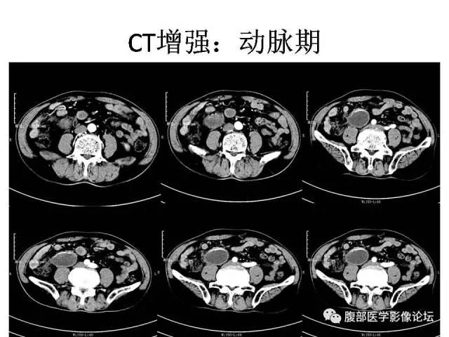 【病例】阑尾粘液囊肿1例CT影像表现