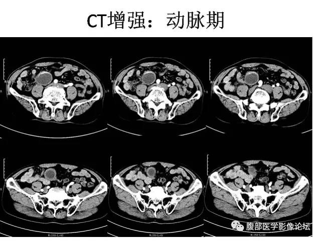 【病例】阑尾粘液囊肿1例CT影像表现