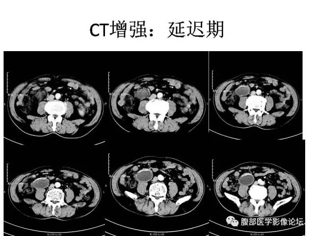【病例】阑尾粘液囊肿1例CT影像表现