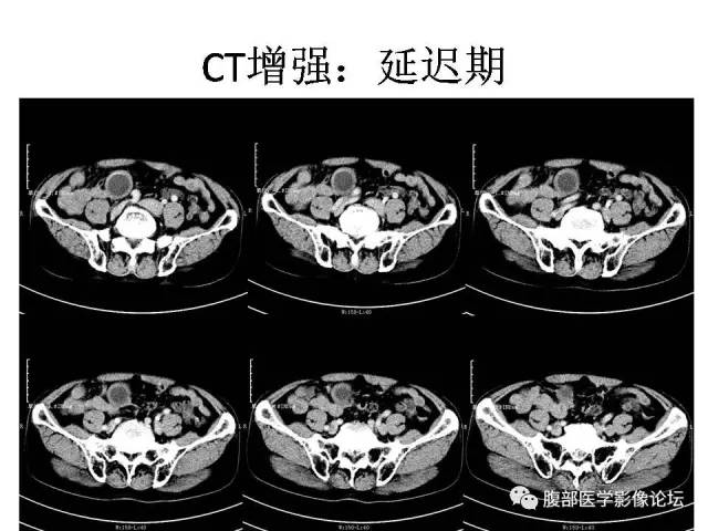 【病例】阑尾粘液囊肿1例CT影像表现