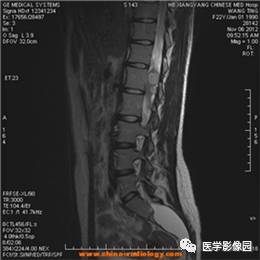 【病例】椎管内畸胎瘤1例MR影像表现 【病例】椎管内畸胎瘤1例MR影像表现