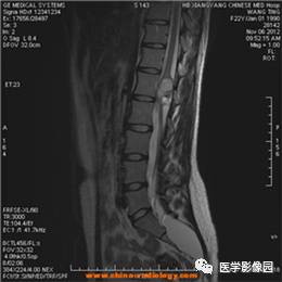 【病例】椎管内畸胎瘤1例MR影像表现 【病例】椎管内畸胎瘤1例MR影像表现