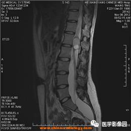 【病例】椎管内畸胎瘤1例MR影像表现