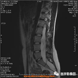 【病例】椎管内畸胎瘤1例MR影像表现 【病例】椎管内畸胎瘤1例MR影像表现