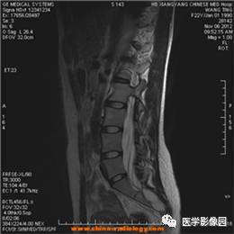 【病例】椎管内畸胎瘤1例MR影像表现 【病例】椎管内畸胎瘤1例MR影像表现