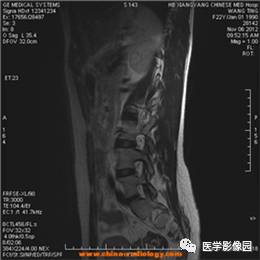 【病例】椎管内畸胎瘤1例MR影像表现 【病例】椎管内畸胎瘤1例MR影像表现