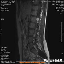 【病例】椎管内畸胎瘤1例MR影像表现 【病例】椎管内畸胎瘤1例MR影像表现