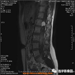 【病例】椎管内畸胎瘤1例MR影像表现 【病例】椎管内畸胎瘤1例MR影像表现