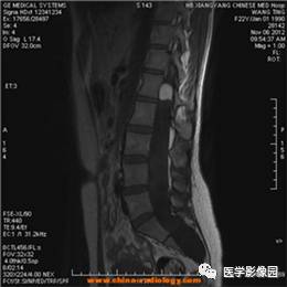 【病例】椎管内畸胎瘤1例MR影像表现 【病例】椎管内畸胎瘤1例MR影像表现
