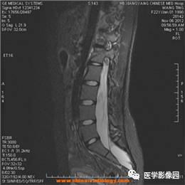 【病例】椎管内畸胎瘤1例MR影像表现 【病例】椎管内畸胎瘤1例MR影像表现