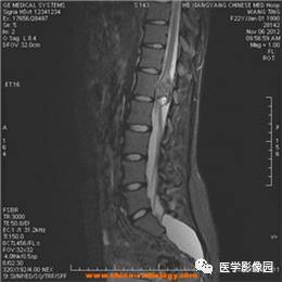 【病例】椎管内畸胎瘤1例MR影像表现 【病例】椎管内畸胎瘤1例MR影像表现