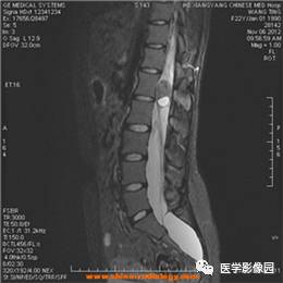 【病例】椎管内畸胎瘤1例MR影像表现 【病例】椎管内畸胎瘤1例MR影像表现