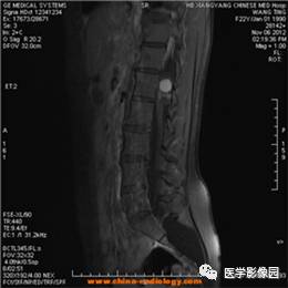 【病例】椎管内畸胎瘤1例MR影像表现 【病例】椎管内畸胎瘤1例MR影像表现