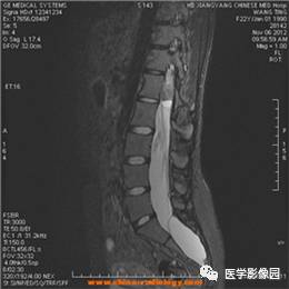 【病例】椎管内畸胎瘤1例MR影像表现 【病例】椎管内畸胎瘤1例MR影像表现