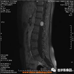 【病例】椎管内畸胎瘤1例MR影像表现 【病例】椎管内畸胎瘤1例MR影像表现