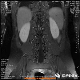 【病例】椎管内畸胎瘤1例MR影像表现 【病例】椎管内畸胎瘤1例MR影像表现