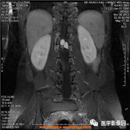 【病例】椎管内畸胎瘤1例MR影像表现 【病例】椎管内畸胎瘤1例MR影像表现