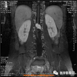 【病例】椎管内畸胎瘤1例MR影像表现 【病例】椎管内畸胎瘤1例MR影像表现