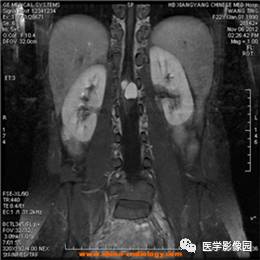 【病例】椎管内畸胎瘤1例MR影像表现 【病例】椎管内畸胎瘤1例MR影像表现
