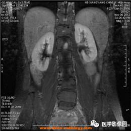 【病例】椎管内畸胎瘤1例MR影像表现 【病例】椎管内畸胎瘤1例MR影像表现
