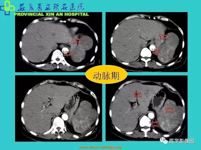 【病例】原发性脾血管内皮肉瘤1例CT影像表现 【病例】原发性脾血管内皮肉瘤1例CT影像表现