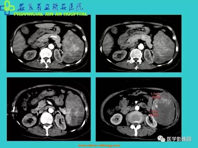 【病例】原发性脾血管内皮肉瘤1例CT影像表现 【病例】原发性脾血管内皮肉瘤1例CT影像表现