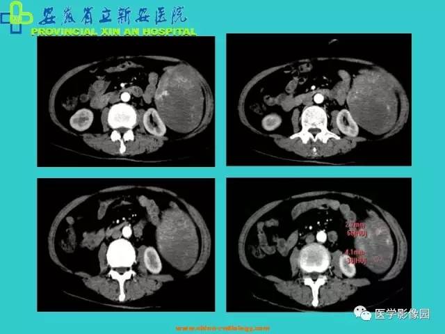 【病例】原发性脾血管内皮肉瘤1例CT影像表现 【病例】原发性脾血管内皮肉瘤1例CT影像表现