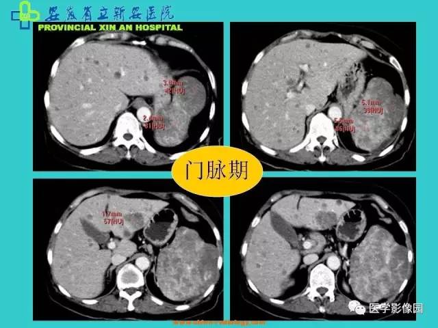 【病例】原发性脾血管内皮肉瘤1例CT影像表现 【病例】原发性脾血管内皮肉瘤1例CT影像表现