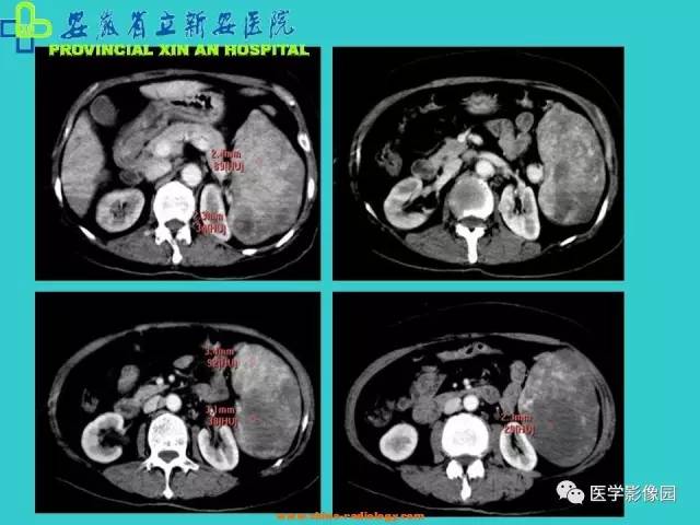 【病例】原发性脾血管内皮肉瘤1例CT影像表现 【病例】原发性脾血管内皮肉瘤1例CT影像表现