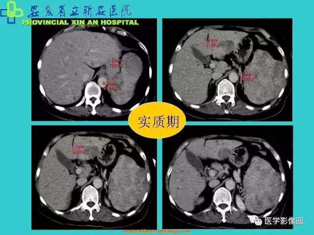 【病例】原发性脾血管内皮肉瘤1例CT影像表现 【病例】原发性脾血管内皮肉瘤1例CT影像表现