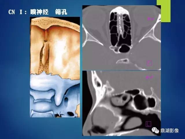 【PPT】12对颅神经影像检查