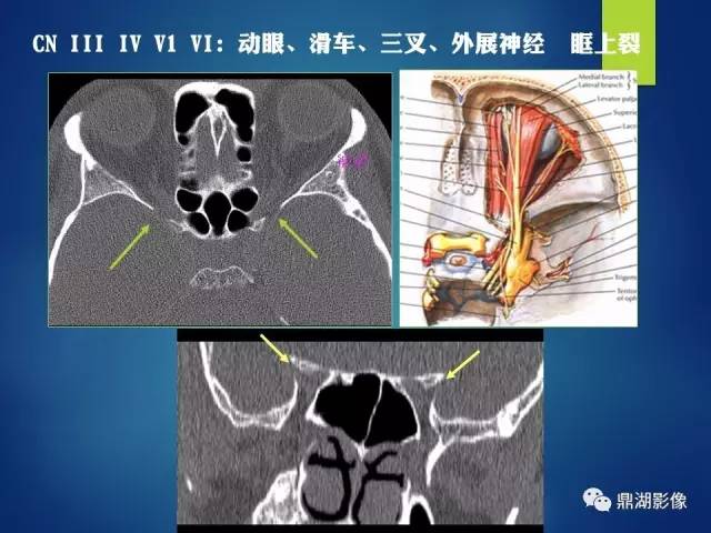【PPT】12对颅神经影像检查