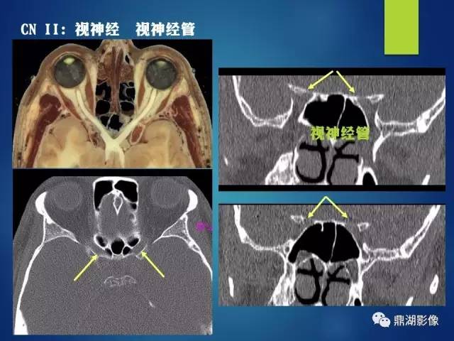 【PPT】12对颅神经影像检查