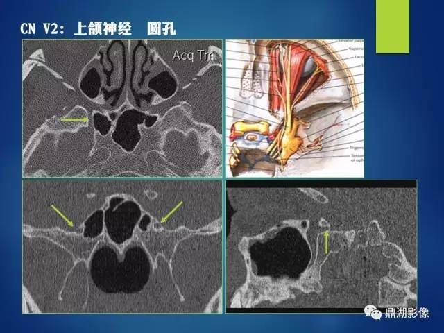 【PPT】12对颅神经影像检查