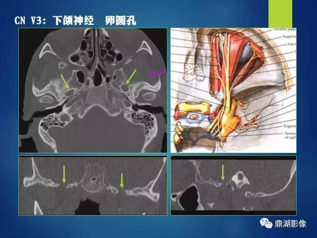 【PPT】12对颅神经影像检查