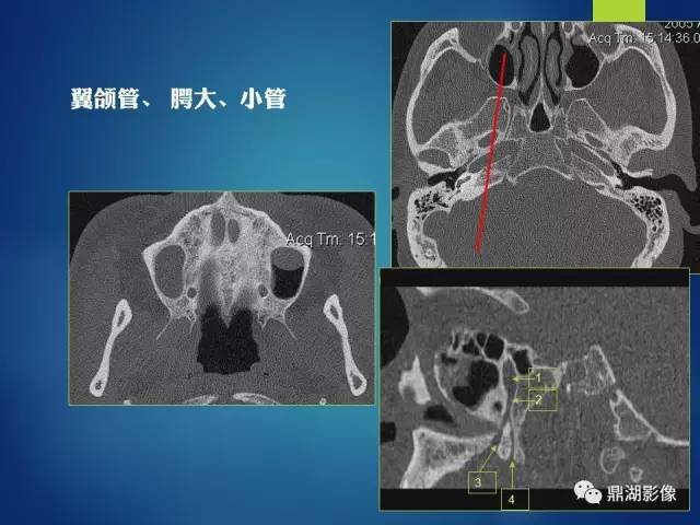 【PPT】12对颅神经影像检查