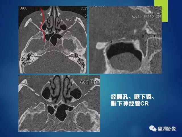 【PPT】12对颅神经影像检查