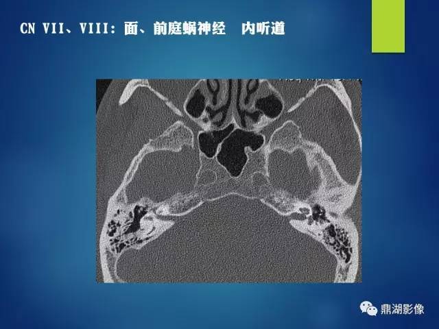 【PPT】12对颅神经影像检查
