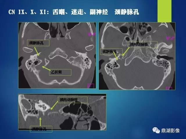 【PPT】12对颅神经影像检查