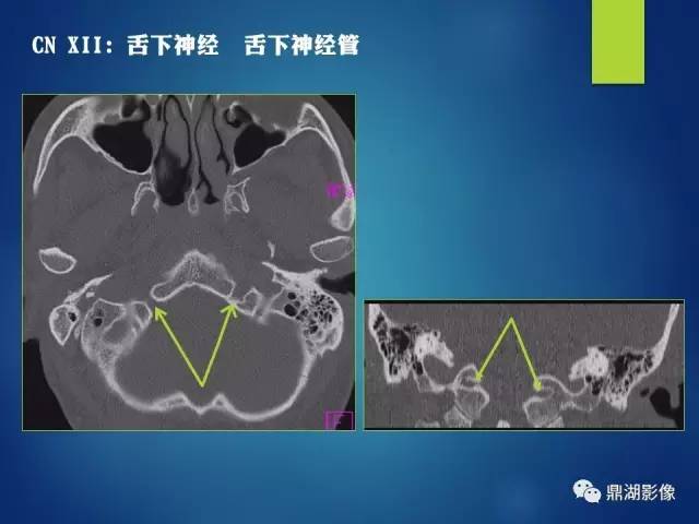 【PPT】12对颅神经影像检查