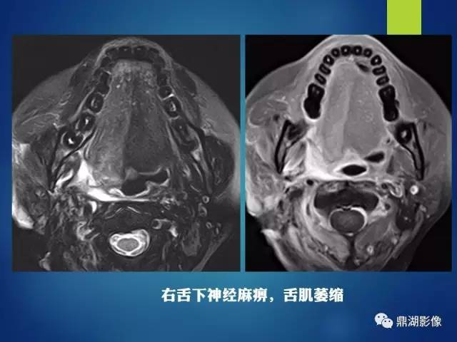 【PPT】12对颅神经影像检查