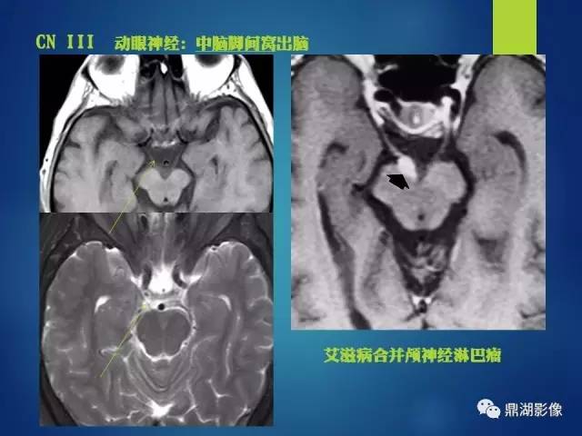 【PPT】12对颅神经影像检查