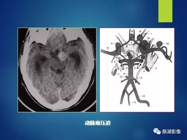 【PPT】12对颅神经影像检查