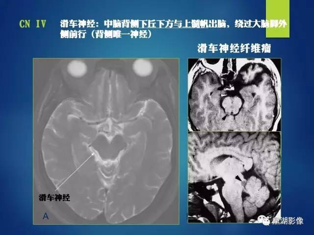 【PPT】12对颅神经影像检查