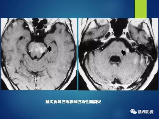 【PPT】12对颅神经影像检查