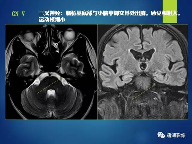 【PPT】12对颅神经影像检查