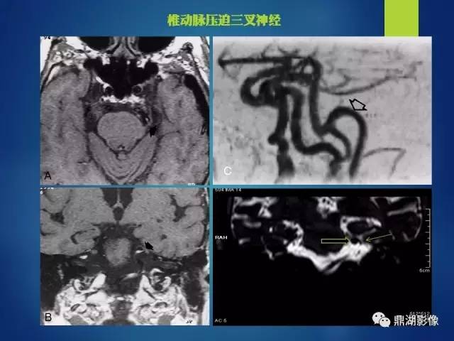 【PPT】12对颅神经影像检查